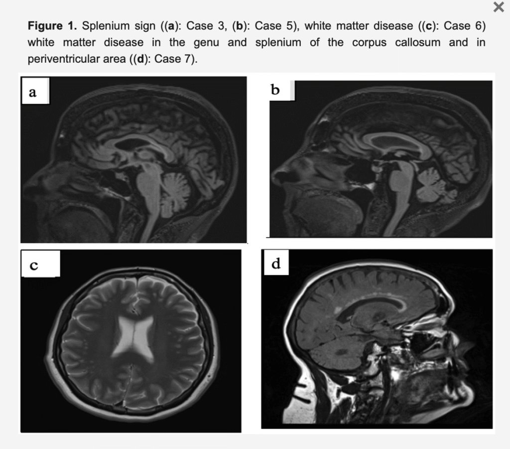 Premutation Females with preFXTAS