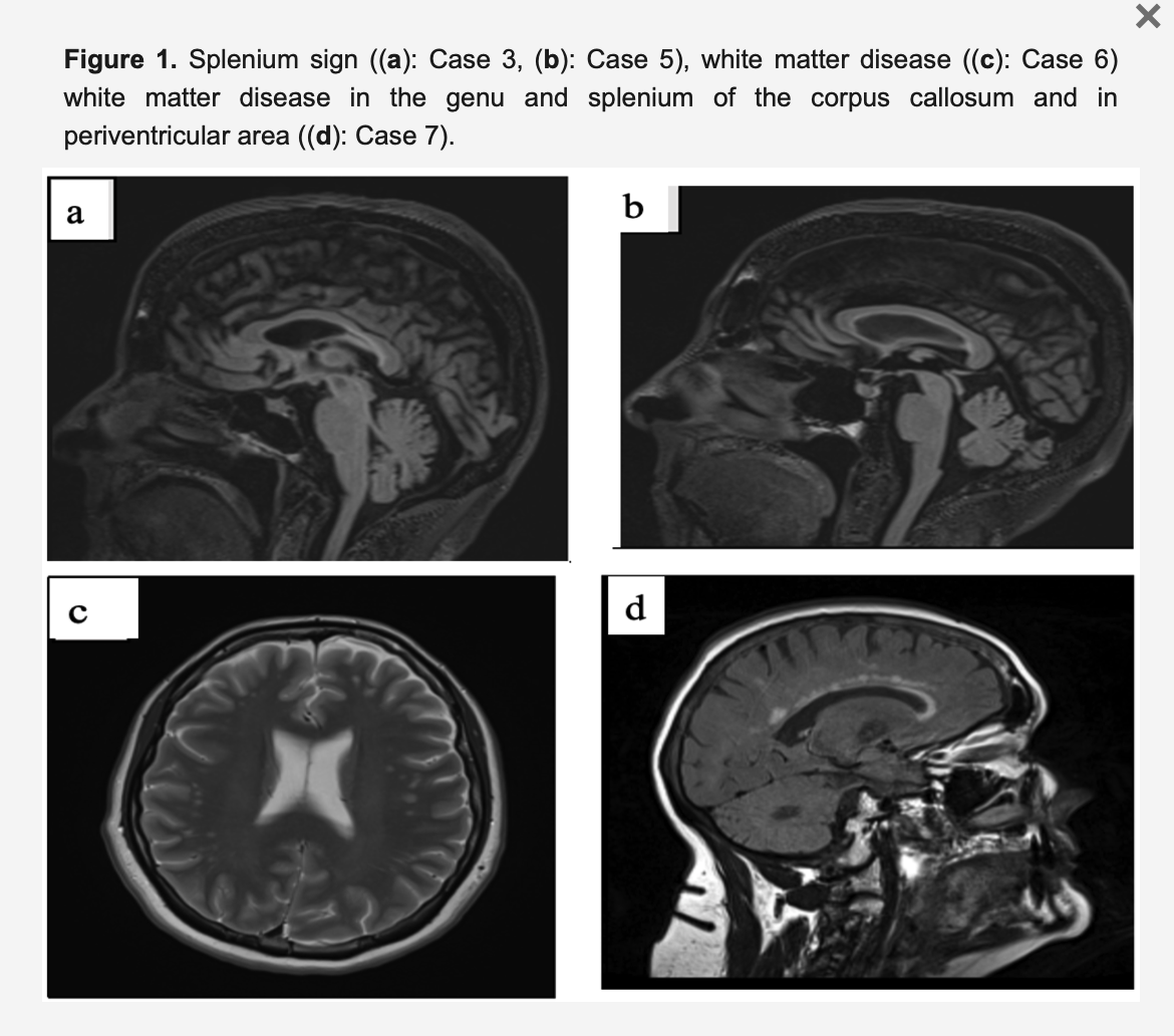 Premutation Females with preFXTAS