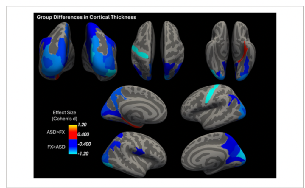 Significant group differences in cortical thickness between FXS and ASD